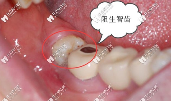 阻生智齒也可以通過牽引來替代磨牙