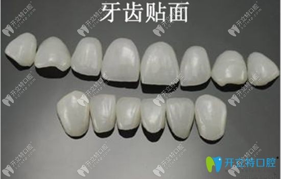 牙齿贴面的展示图