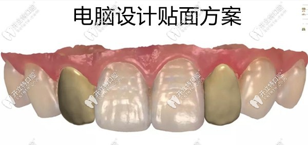 經(jīng)電腦輔助設(shè)計(jì)的側(cè)切牙貼面形態(tài)