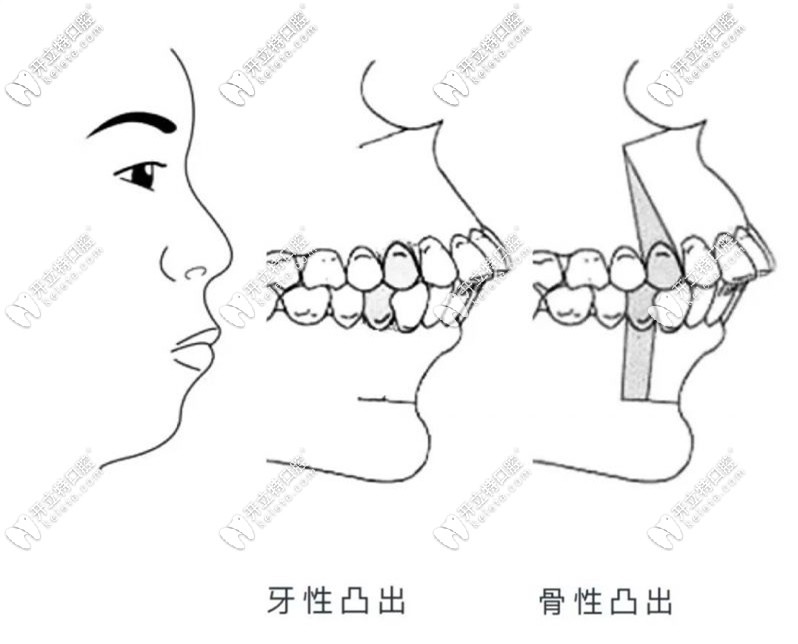 齿性凸嘴和骨性凸嘴