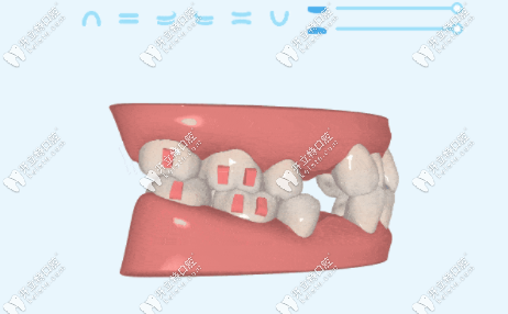 時(shí)代天使是國產(chǎn)的，而隱適美是美國的