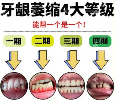 牙周炎引起的牙齦萎縮