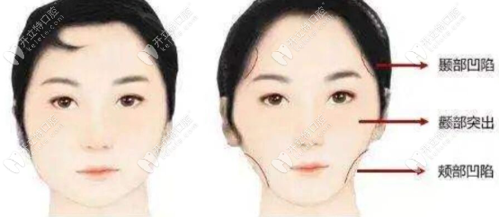 牙齿矫正后脸垮了