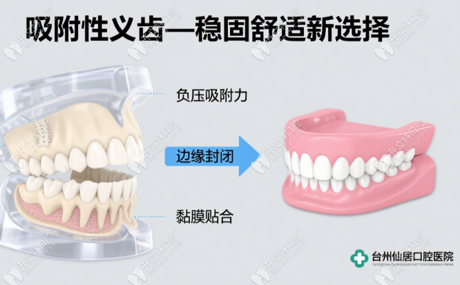 臺州仙居口腔醫(yī)院吸附性義齒價格表:全口bps28000元起,當(dāng)天戴!