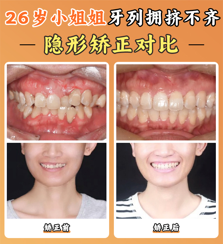 北医三院正颌手术费用构成与参考