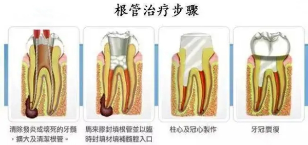 杭州西湖口腔醫(yī)院根管治療價(jià)格公開：前牙488元起，顯微技術(shù)2000元起保真牙