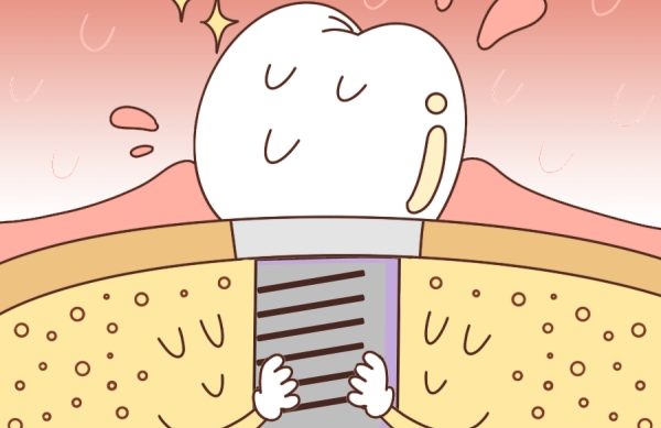 瑞士士卓曼鈦鋯瑞鋯系列種植體