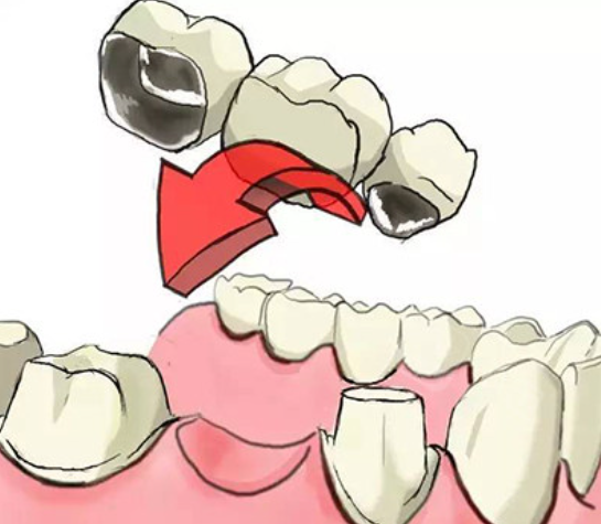 廣州搭橋全瓷牙的醫(yī)生團(tuán)隊與技術(shù)特色