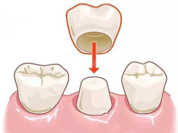 如何選擇適合自己的搭橋全瓷牙醫(yī)院