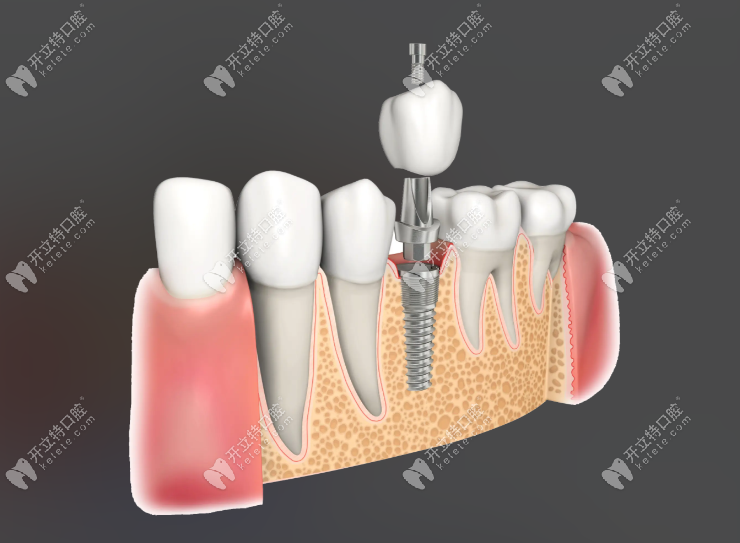 種植牙結(jié)構(gòu)示意圖 種植牙結(jié)構(gòu)示意圖