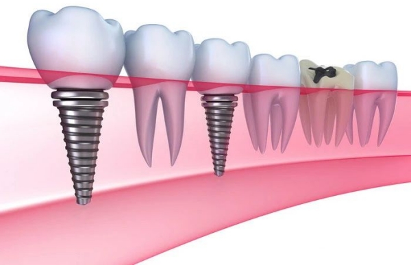 應(yīng)彬彬醫(yī)生種植牙
