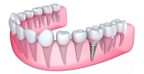 應(yīng)彬彬種植牙價格