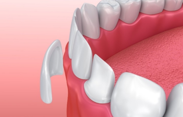 全瓷貼面性價(jià)比高嗎