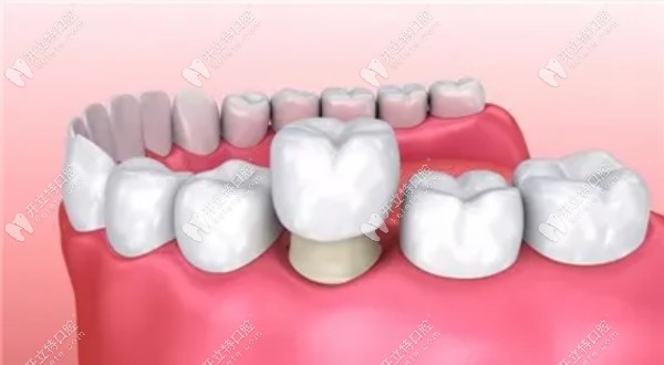 儒伽種植體和韓國種植體奧齒泰價格