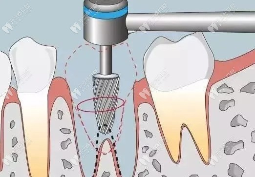 儒伽種植體和韓國種植體奧齒泰