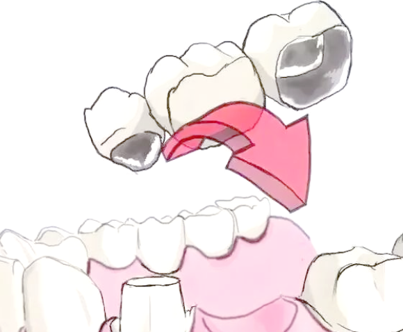 连云港做烤瓷牙，这些注意事项能帮你省不少钱！