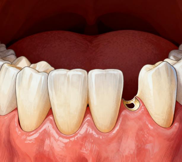 连云港烤瓷牙价格表2026年更新！全瓷牙、金属烤瓷牙单颗1500-5000元