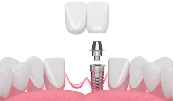 深圳美力口腔2025年收费标准解析