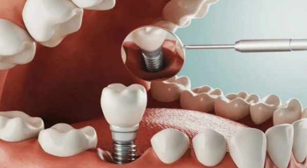 在融水看牙避坑指南：記住這幾點(diǎn)，再也不怕被“套路”！