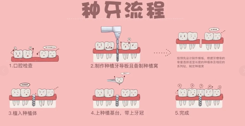 北京廷杰口腔種牙后注意事項(xiàng)別忽視，這些細(xì)節(jié)不注意可能白花錢