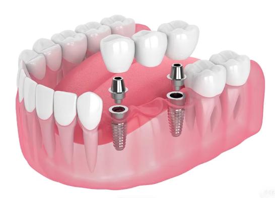 保定一加一口腔門診部種牙用戶真實反饋