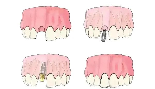 常州中諾口腔種牙體驗(yàn)：從詢問到戴牙，全程貼心有確保
