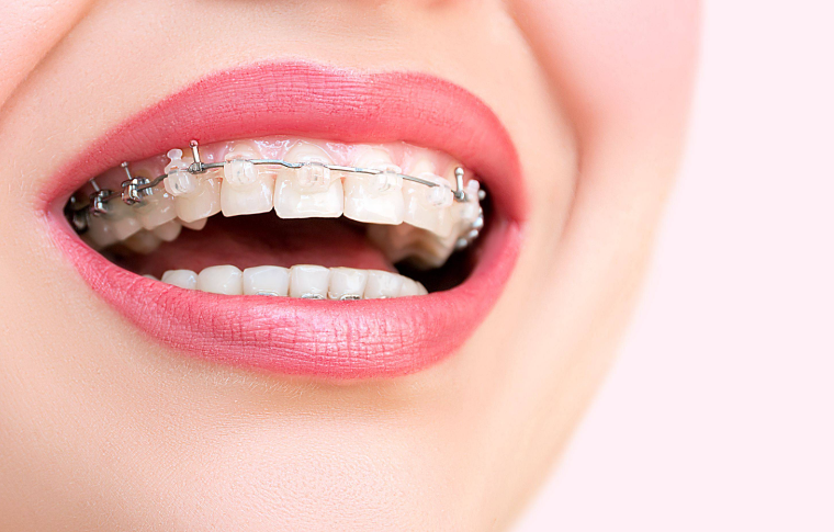 睢寧美佳口腔正畸怎么樣？2025新版測評：杜院長親診案例+價格表全公開！