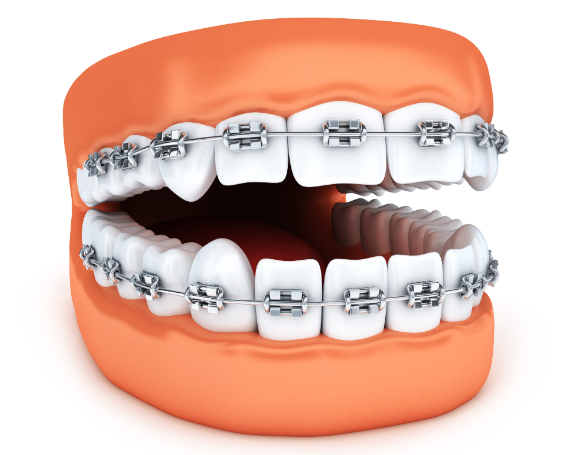 影響矯正價格的關(guān)鍵因素gh0097.com