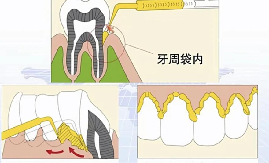 廣州德倫口腔牙周治療中心怎么樣？80%牙友說(shuō)牙周維護(hù)到位，做潔牙刮治根面平整都很穩(wěn)