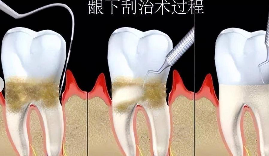 四、廣州德倫vs穗華/廣大口腔：牙周深度清潔性?xún)r(jià)比更高的原因