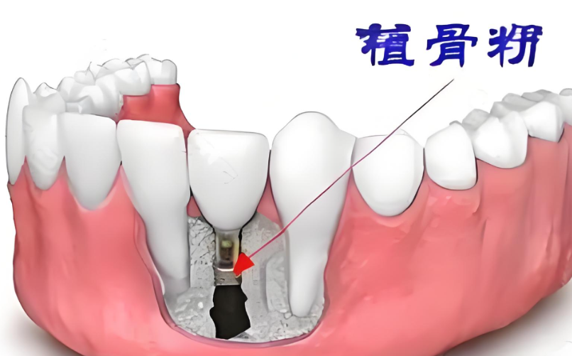 牙周植骨手術(shù)多少錢？0.5克骨粉3千+骨膜2千，費用拆解不踩坑