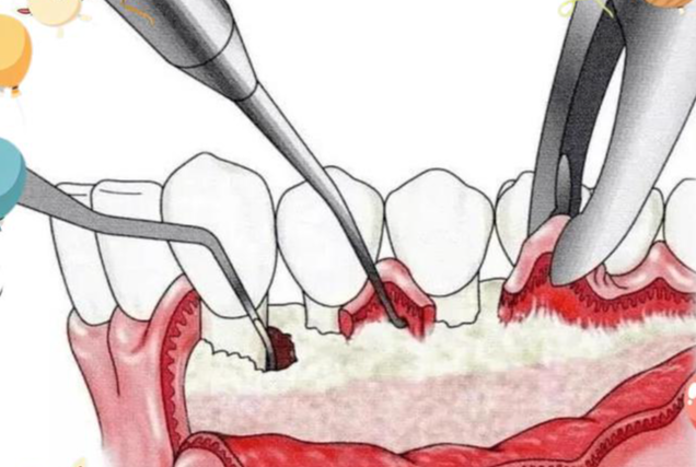 牙周植骨手術(shù)其他必要費(fèi)用：這些細(xì)節(jié)別忽略，避免臨時(shí)加錢(qián)