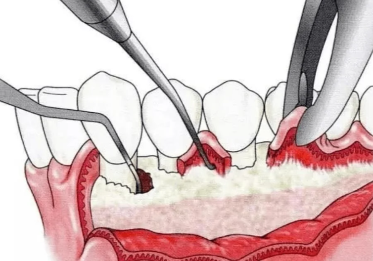 牙齦翻瓣術(shù)3D演示像 “大手術(shù)”？真相：創(chuàng)傷小，風(fēng)險(xiǎn)可控