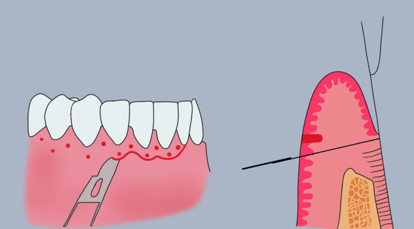 牙齦翻瓣術(shù)圖解步驟詳解：10年牙醫(yī)教你看懂關(guān)鍵環(huán)節(jié)