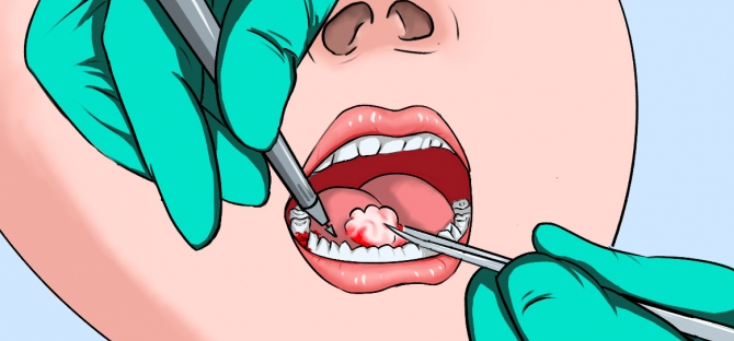 牙齦翻瓣術(shù)切口設(shè)計：10年牙醫(yī)的3個核心原則