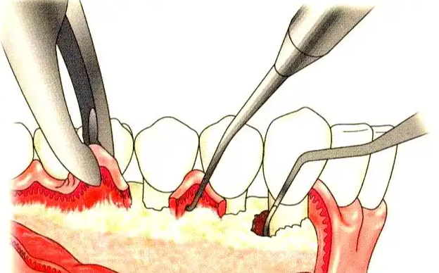 牙齦翻瓣術(shù)價格拆解：私立機構(gòu)常見收費與影響因素