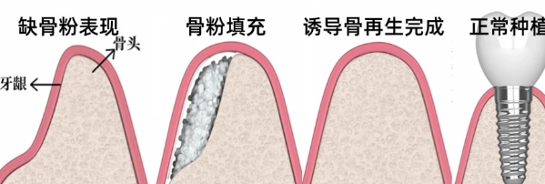 牙齒骨量不足的圖片對比：牙齦萎縮和骨量少的區(qū)別，3種補救方法親測有效