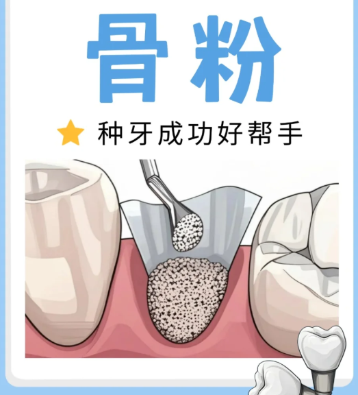 3 種補(bǔ)救方法親測(cè)有效，骨量不足也能順利種牙