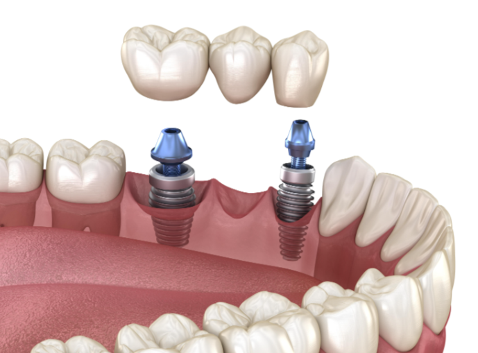 廣州光華口腔醫(yī)院種植科：影響門牙種植收費的核心因素