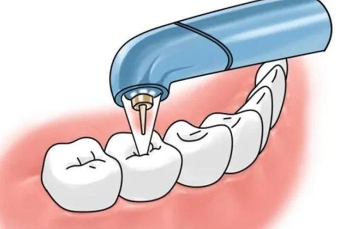 四、深圳格倫菲爾與其他機構(gòu)牙周治療價格對比