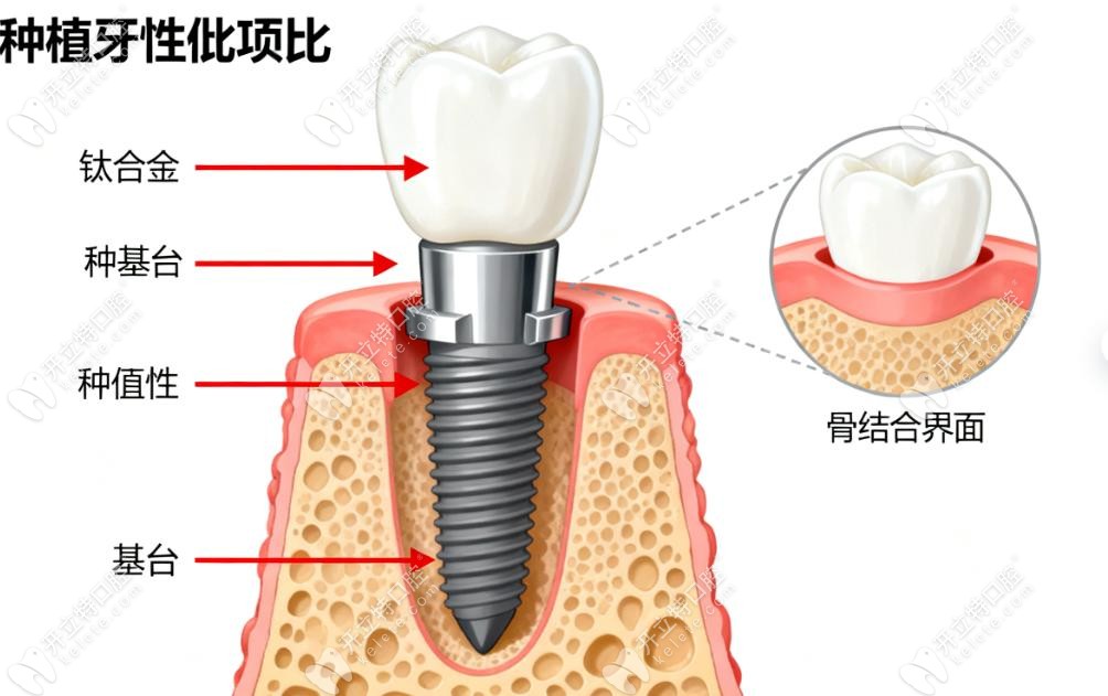 說(shuō)下為什么我非常后悔做了種植牙