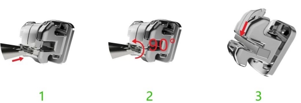 七、牙齒矯正常見問題專門解答