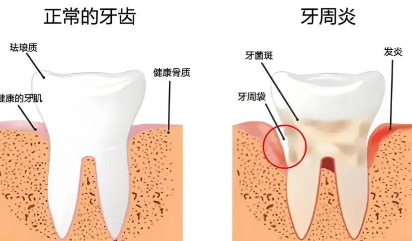 二、關于牙周炎治療的收費情況，這幾點要了解