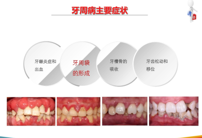 四、杭州私立牙科醫(yī)院牙周治療特色技術解析