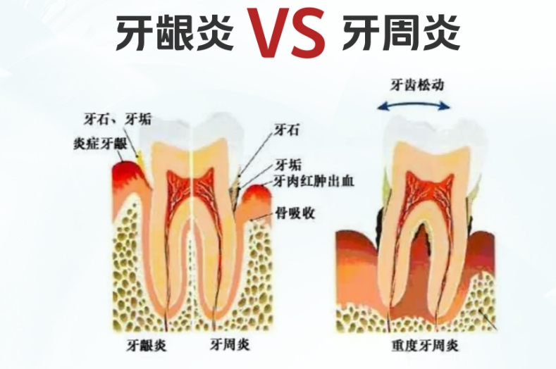 五、牙周炎治療常見問題與專門建議m.gh0097.com