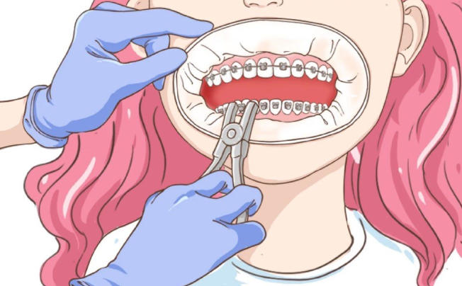 二、關(guān)于蘇州齙牙矯正費(fèi)用的收費(fèi)，這幾點(diǎn)要了解ardc-srvc.com