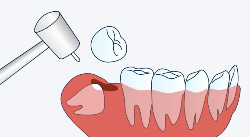 5. 高位阻生智齒拔除