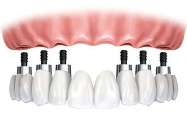 專門總結(jié)：關(guān)于種植體品牌選擇的明智建議