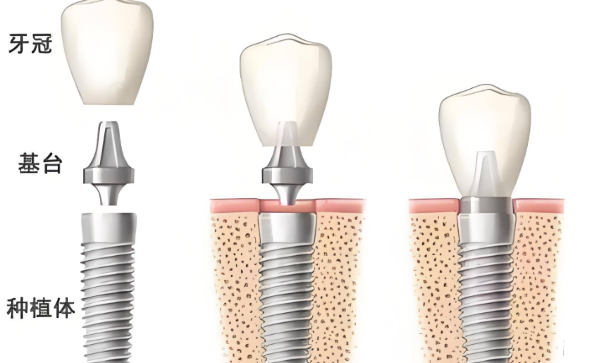 二、關(guān)于種植牙美國(guó)好還是以色列的收費(fèi)差異解析