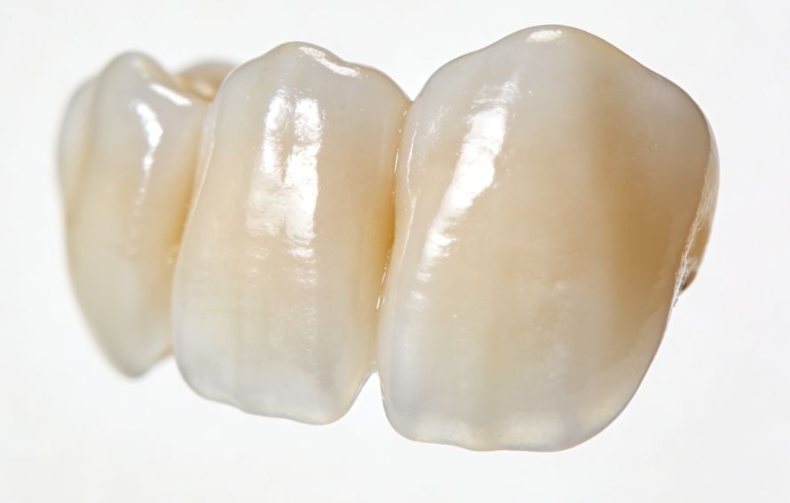 六、深圳全瓷牙冠選擇總結(jié)與建議